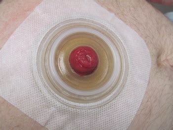 what to do when ostomy bag keeps leaking|Stoma Bleeding and Irritation 